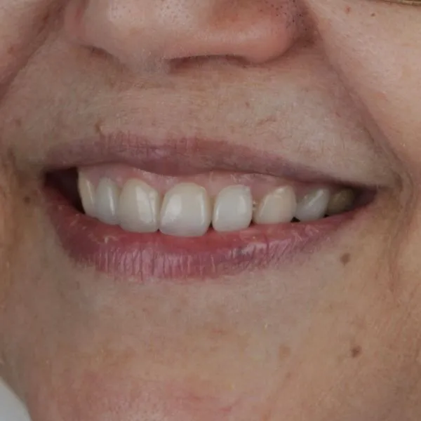 حالة فينير الأسنان في عيادة TRÍO