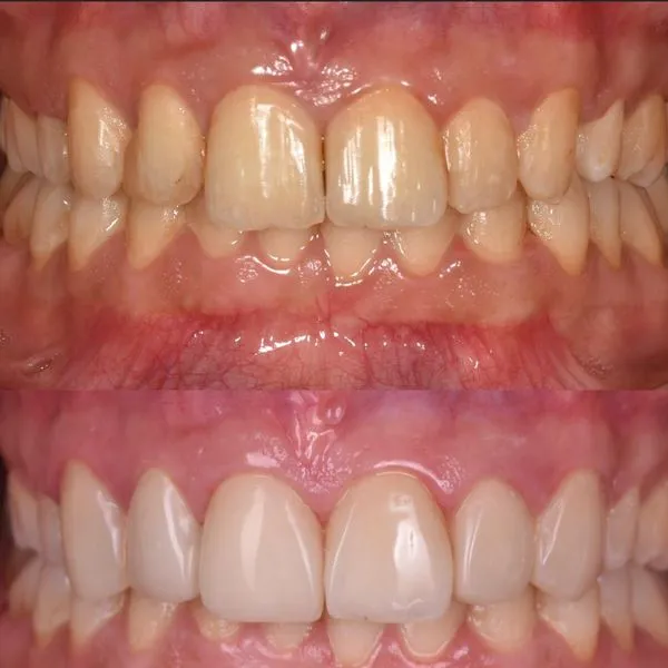 حالة تجميل الأسنان في عيادة TRÍO